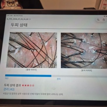 눈으로 확인하는 두피상태 - 고운온도 블로그