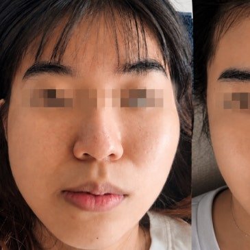 범계 안면비대칭 관리|두통과 함께 불편했던 얼굴 좌우 밸런스, 3개월 관리 사례 - 고운온도 블로그