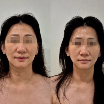 [고운온도 시그니처 관리 사례] 같은 90분이어도 관리가 다른 이유 | 범계에스테틱 - 고운온도 블로그